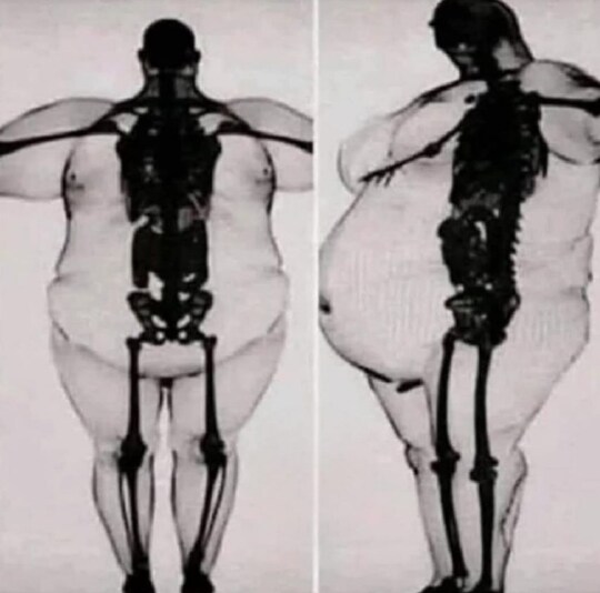 This X-ray reveals a harsh truth behind severe obesity: while the bones themselves remain the same, they bear an immense and damaging strain from the excess body mass. This strain crushes the spine, gradually deforms the hips and knees, and pushes the heart beyond its limits. Vital organs like the liver and pancreas become overwhelmed, increasing the risk of serious health issues such as cancer, stroke, and diabetes. Excess fat is not merely extra weight—it is dangerous and life-threatening. Obesity is a chronic and complex disease, not just a body type, and while it carries serious risks, it is also both preventable and treatable. Understanding this medical reality is crucial to addressing the condition effectively See less  https://www.facebook.com/photo/?fbid=663890006644230&set=gwww.1706922500188419&idorvanity=1438524067028265