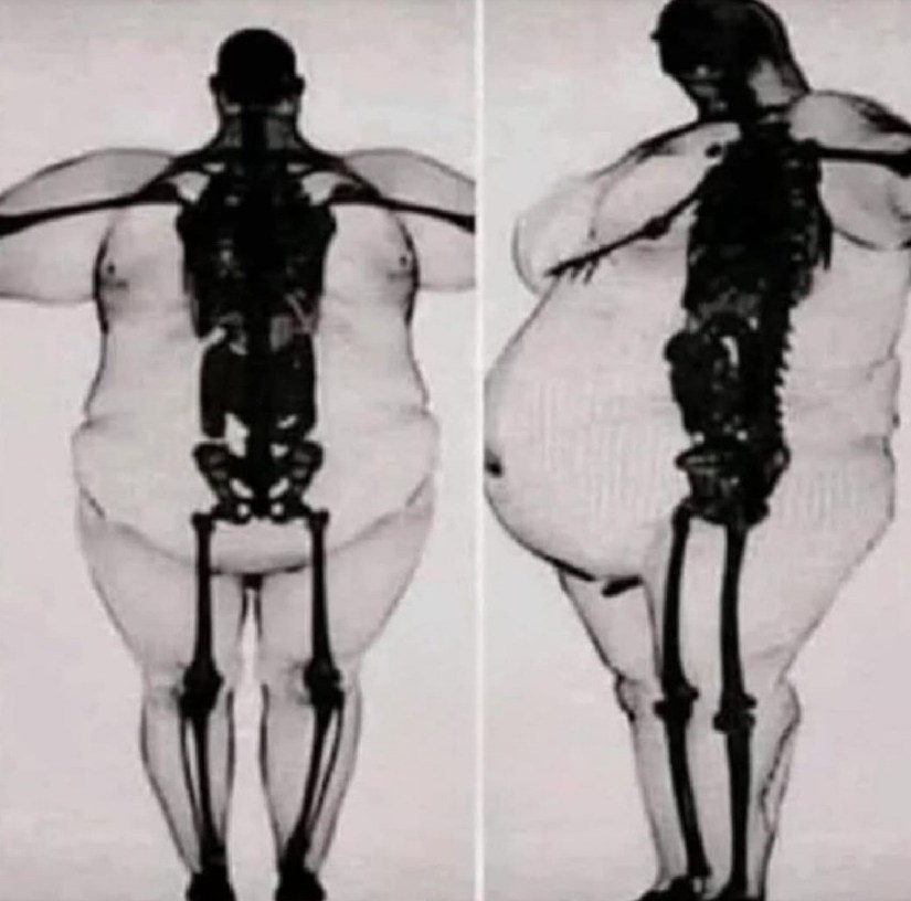 This X-ray reveals a harsh truth behind severe obesity: while the bones themselves remain the same, they bear an immense and damaging strain from the excess body mass. This strain crushes the spine, gradually deforms the hips and knees, and pushes the heart beyond its limits. Vital organs like the liver and pancreas become overwhelmed, increasing the risk of serious health issues such as cancer, stroke, and diabetes. Excess fat is not merely extra weight—it is dangerous and life-threatening. Obesity is a chronic and complex disease, not just a body type, and while it carries serious risks, it is also both preventable and treatable. Understanding this medical reality is crucial to addressing the condition effectively See less  https://www.facebook.com/photo/?fbid=663890006644230&set=gwww.1706922500188419&idorvanity=1438524067028265