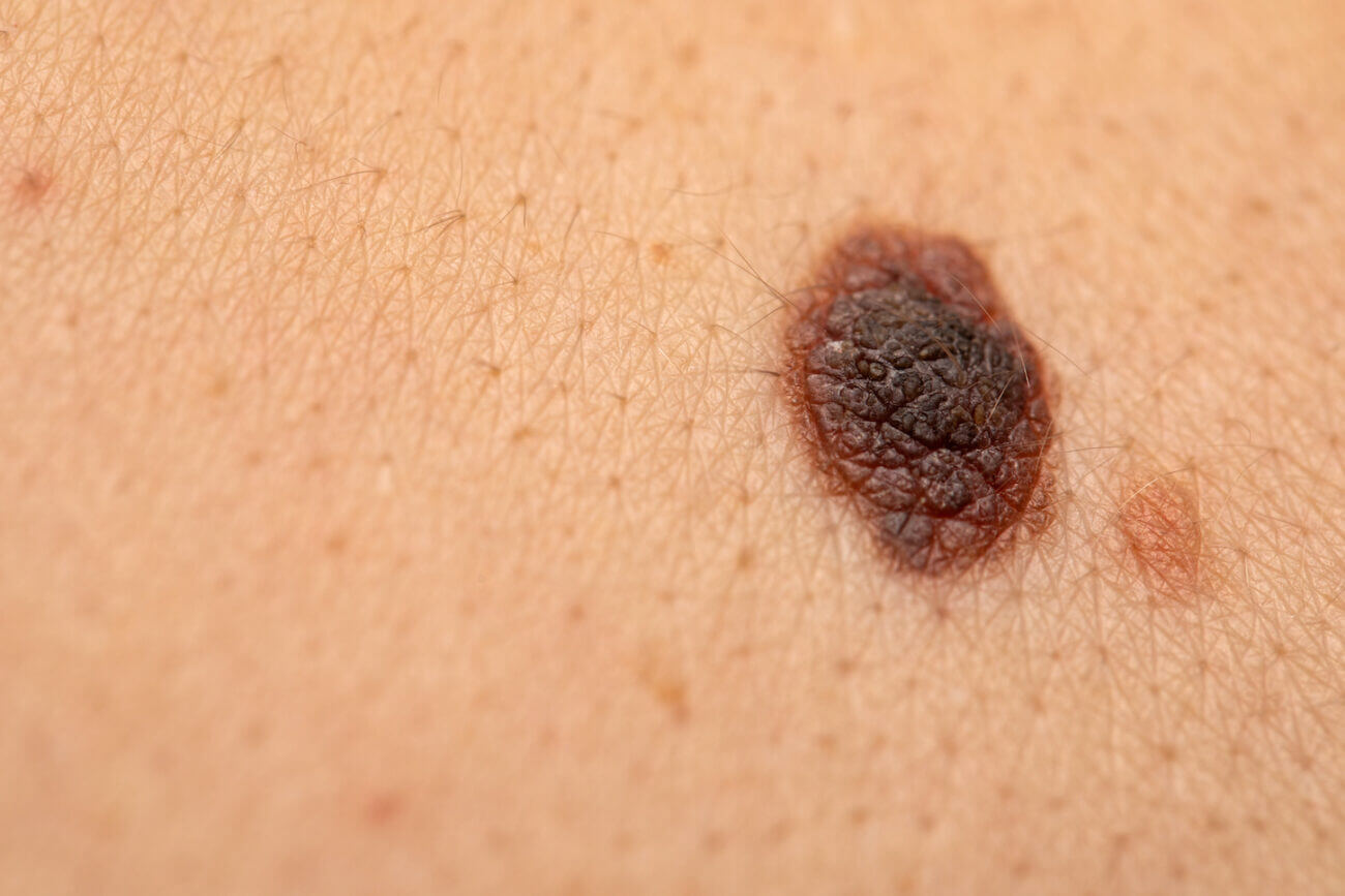 Skin cancer detection apps are designed to ensure that the right people seek medical attention by providing a risk assessment of a new or changing mole by using